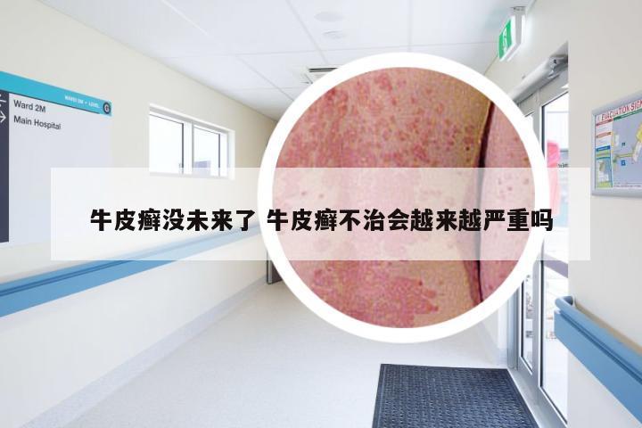 牛皮癣没未来了 牛皮癣不治会越来越严重吗