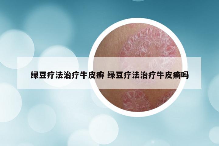 绿豆疗法治疗牛皮癣 绿豆疗法治疗牛皮癣吗