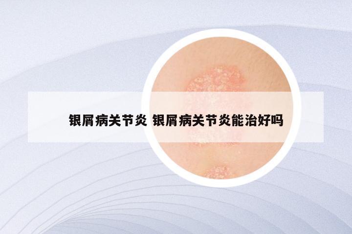 银屑病关节炎 银屑病关节炎能治好吗