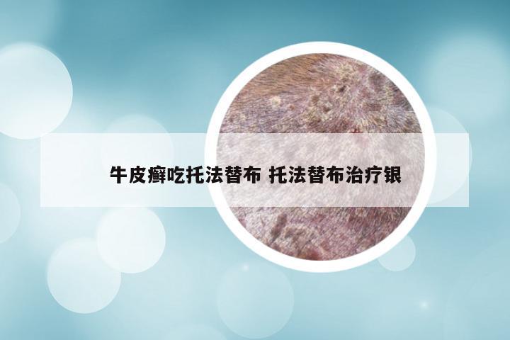 牛皮癣吃托法替布 托法替布治疗银