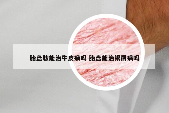 胎盘肽能治牛皮癣吗 胎盘能治银屑病吗