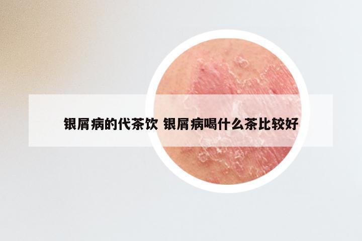 银屑病的代茶饮 银屑病喝什么茶比较好