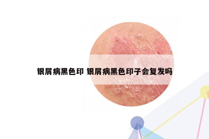 银屑病黑色印 银屑病黑色印子会复发吗