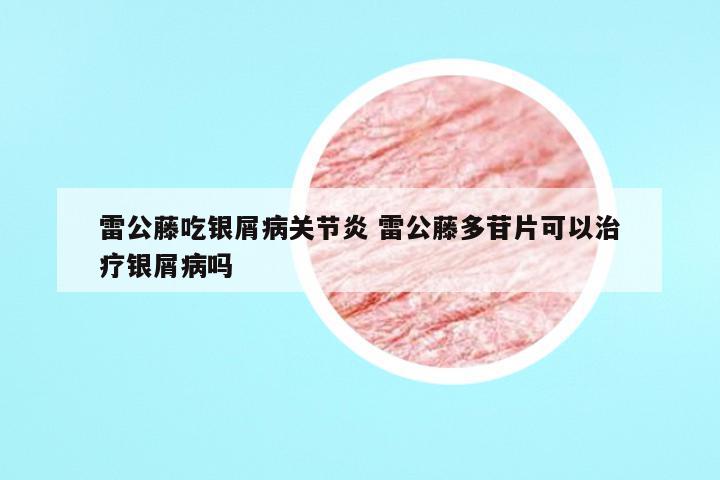 雷公藤吃银屑病关节炎 雷公藤多苷片可以治疗银屑病吗