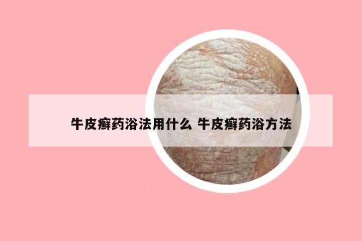 牛皮癣药浴法用什么 牛皮癣药浴方法