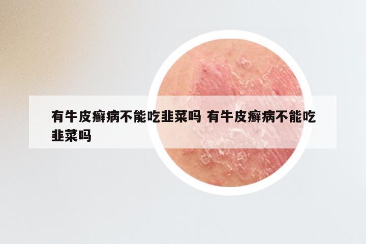 有牛皮癣病不能吃韭菜吗 有牛皮癣病不能吃韭菜吗