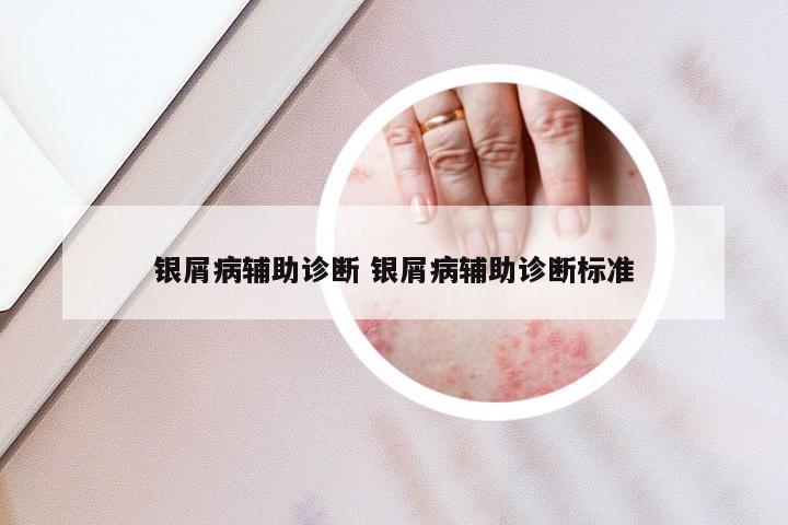 银屑病辅助诊断 银屑病辅助诊断标准