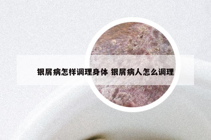 银屑病怎样调理身体 银屑病人怎么调理