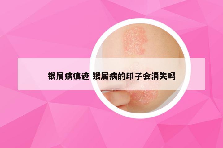 银屑病痕迹 银屑病的印子会消失吗