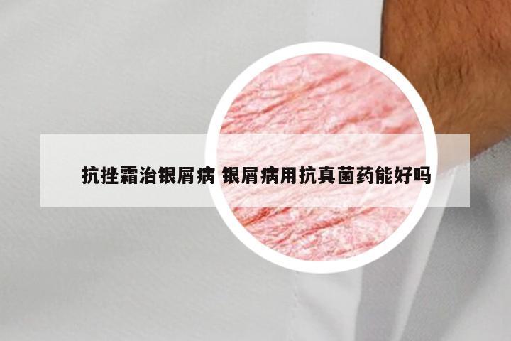 抗挫霜治银屑病 银屑病用抗真菌药能好吗