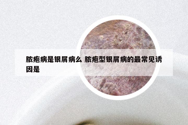 脓疱病是银屑病么 脓疱型银屑病的最常见诱因是