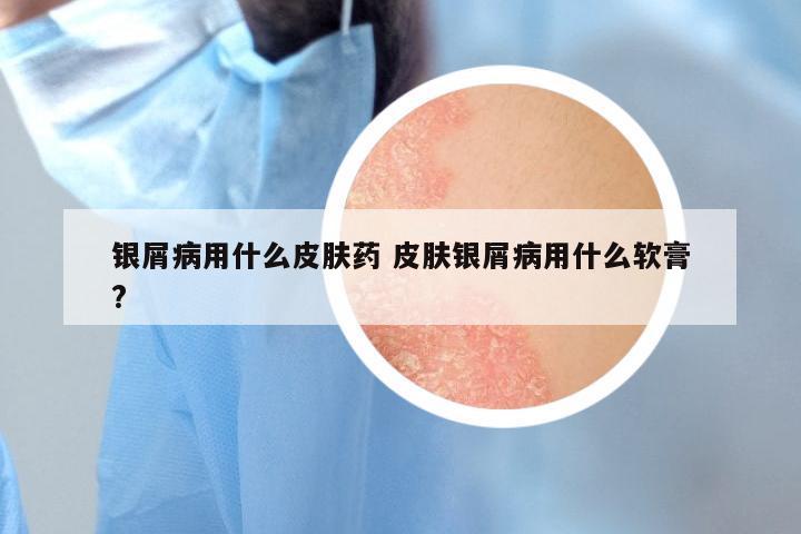 银屑病用什么皮肤药 皮肤银屑病用什么软膏?