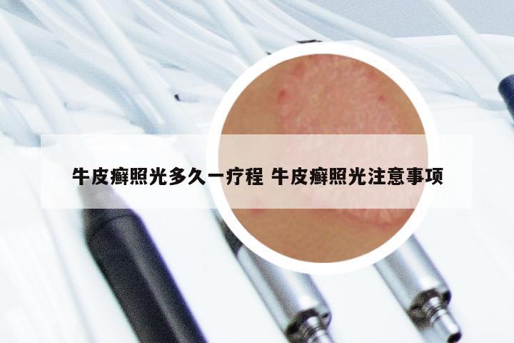 牛皮癣照光多久一疗程 牛皮癣照光注意事项