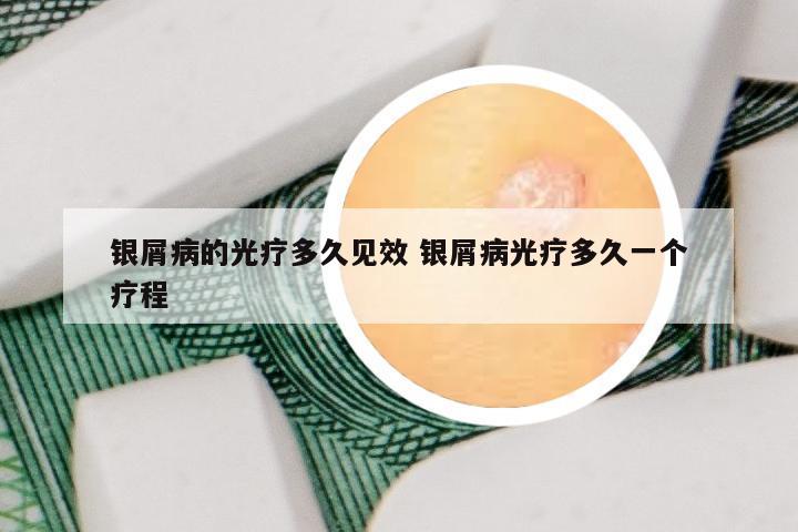 银屑病的光疗多久见效 银屑病光疗多久一个疗程