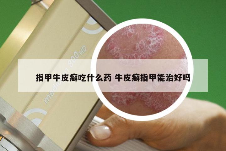 指甲牛皮癣吃什么药 牛皮癣指甲能治好吗