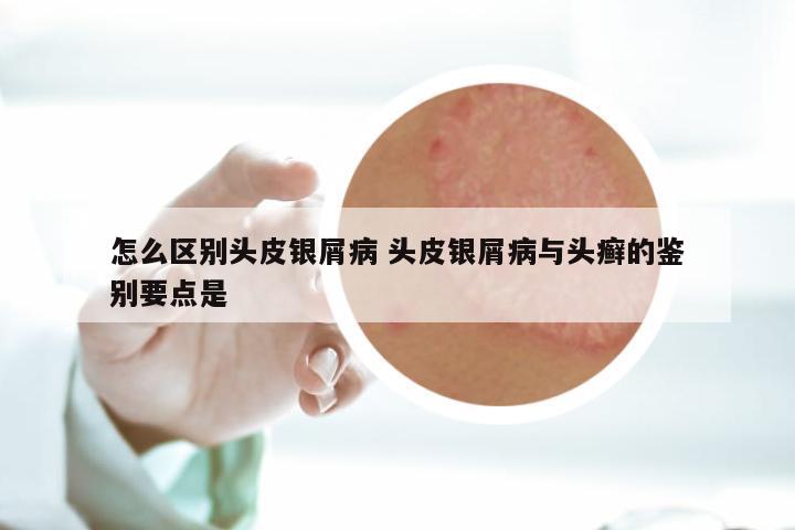 怎么区别头皮银屑病 头皮银屑病与头癣的鉴别要点是