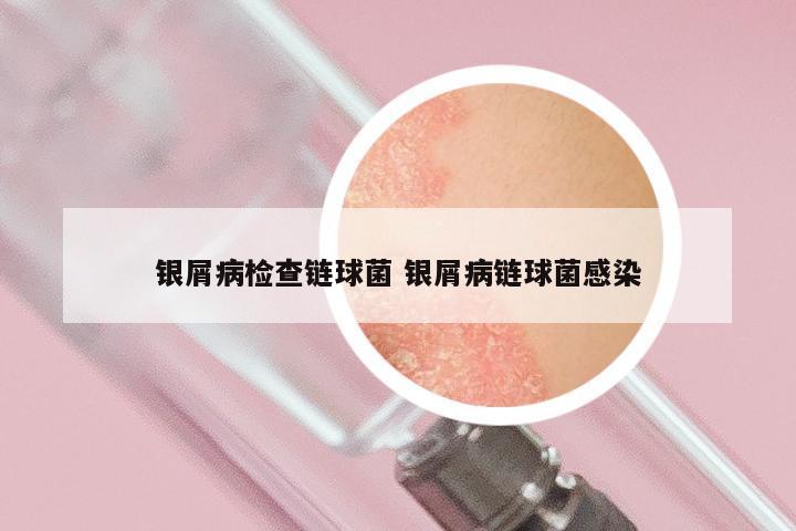 银屑病检查链球菌 银屑病链球菌感染