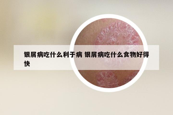 银屑病吃什么利于病 银屑病吃什么食物好得快