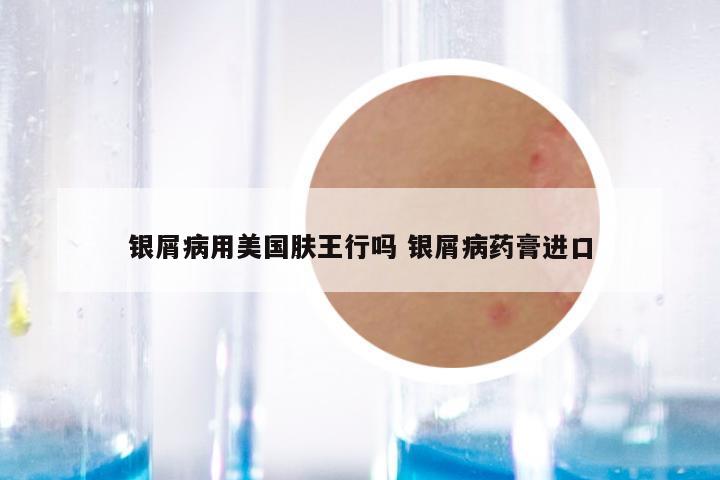 银屑病用美国肤王行吗 银屑病药膏进口