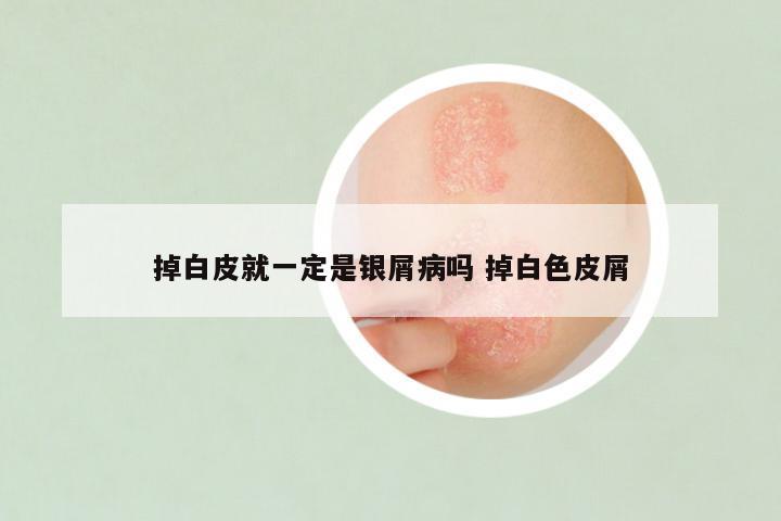 掉白皮就一定是银屑病吗 掉白色皮屑
