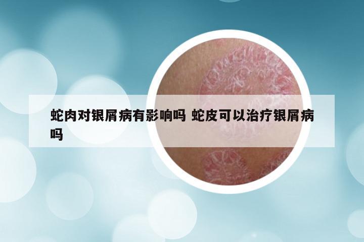 蛇肉对银屑病有影响吗 蛇皮可以治疗银屑病吗