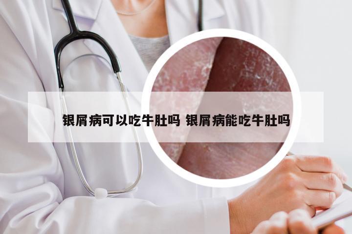 银屑病可以吃牛肚吗 银屑病能吃牛肚吗