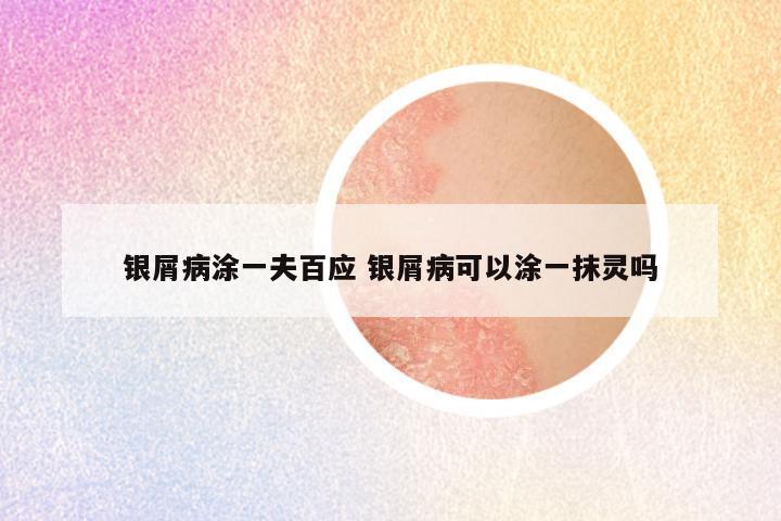 银屑病涂一夫百应 银屑病可以涂一抹灵吗