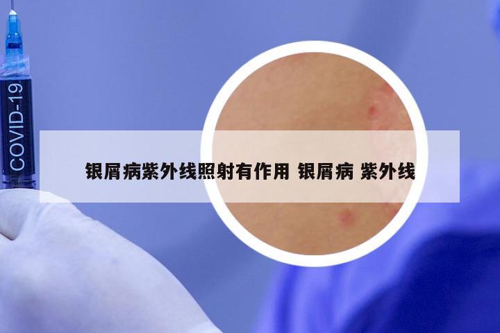 银屑病紫外线照射有作用 银屑病 紫外线