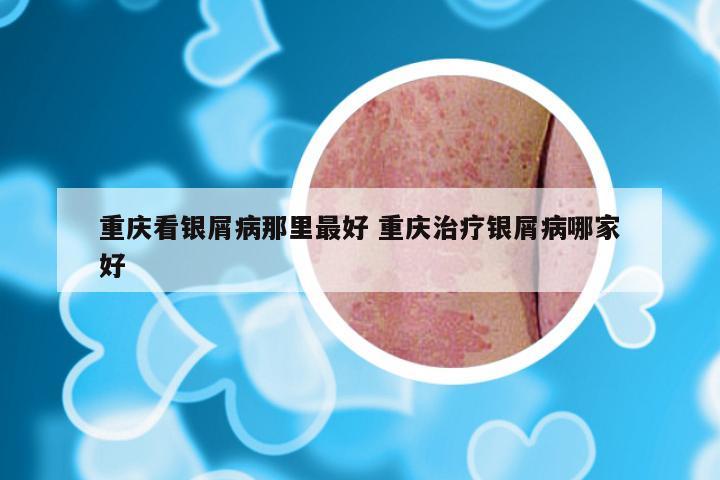 重庆看银屑病那里最好 重庆治疗银屑病哪家好