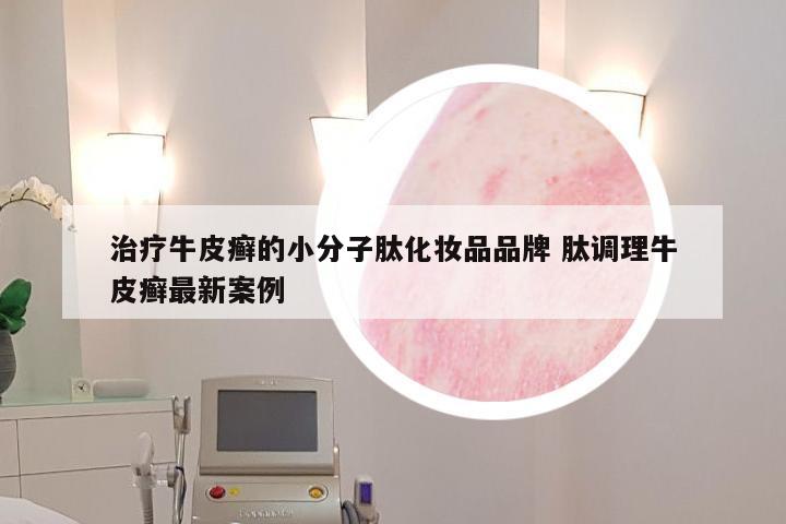治疗牛皮癣的小分子肽化妆品品牌 肽调理牛皮癣最新案例