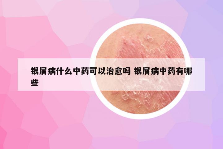 银屑病什么中药可以治愈吗 银屑病中药有哪些