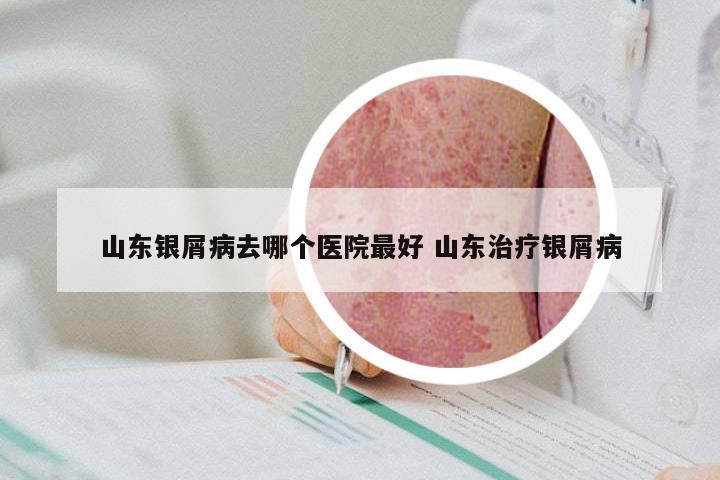 山东银屑病去哪个医院最好 山东治疗银屑病