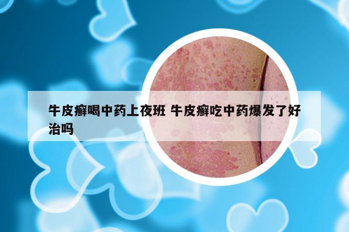 牛皮癣喝中药上夜班 牛皮癣吃中药爆发了好治吗