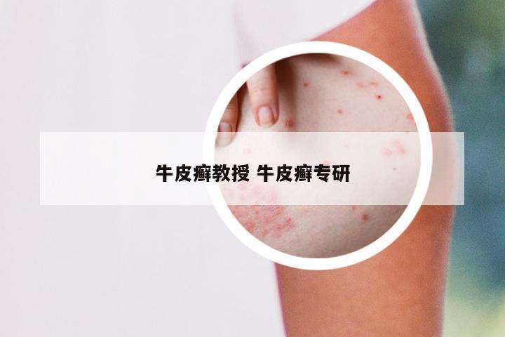 牛皮癣教授 牛皮癣专研