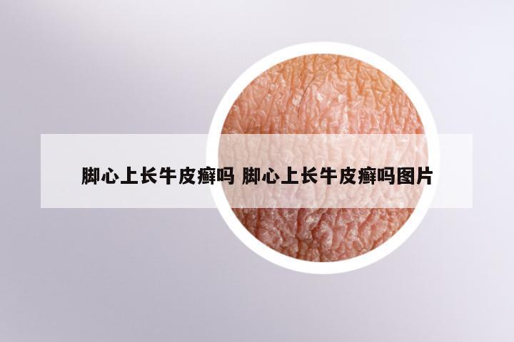 脚心上长牛皮癣吗 脚心上长牛皮癣吗图片