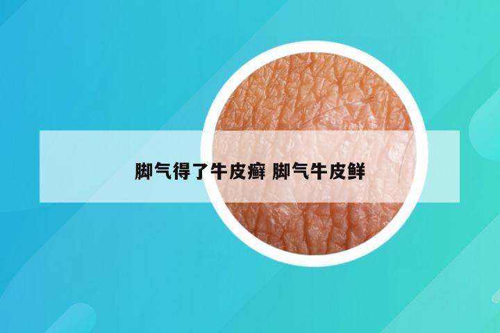 脚气得了牛皮癣 脚气牛皮鲜