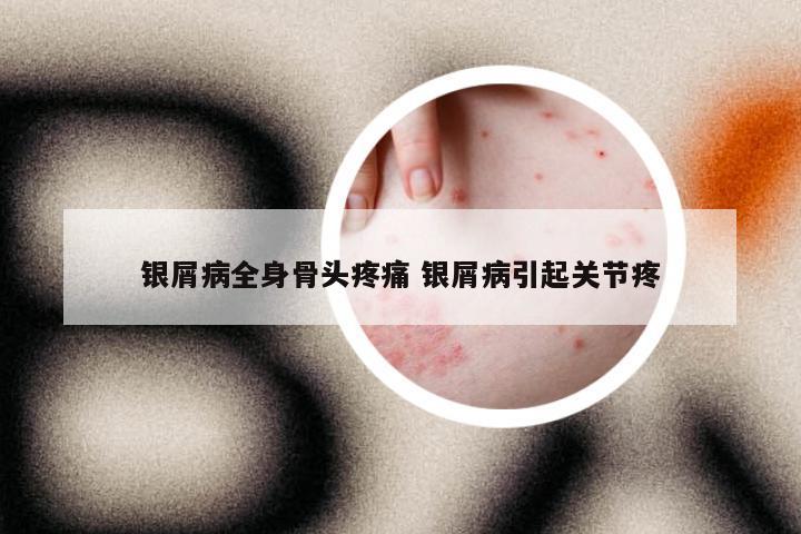 银屑病全身骨头疼痛 银屑病引起关节疼