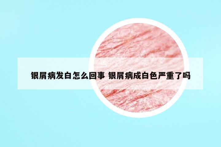 银屑病发白怎么回事 银屑病成白色严重了吗