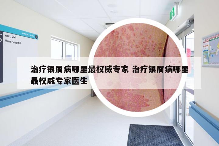 治疗银屑病哪里最权威专家 治疗银屑病哪里最权威专家医生
