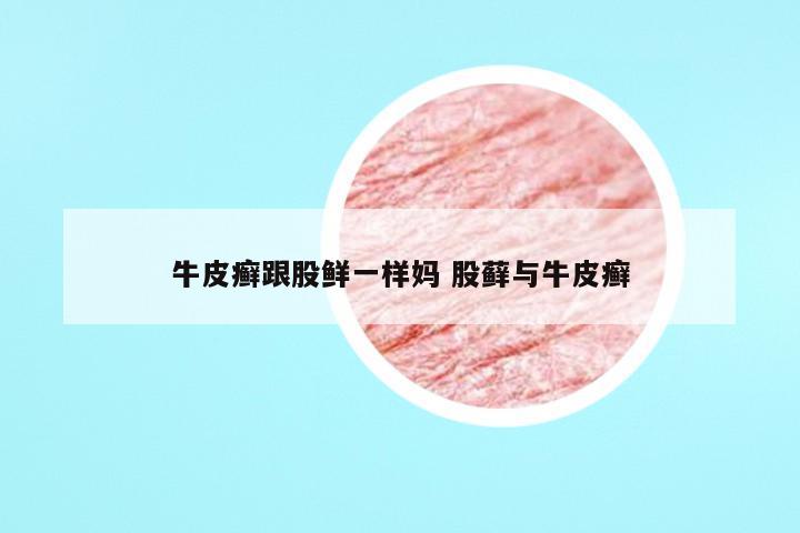 牛皮癣跟股鲜一样妈 股藓与牛皮癣