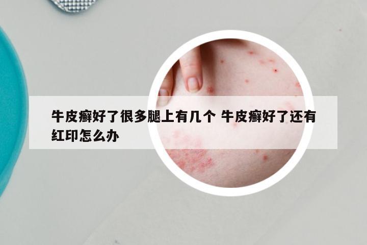 牛皮癣好了很多腿上有几个 牛皮癣好了还有红印怎么办