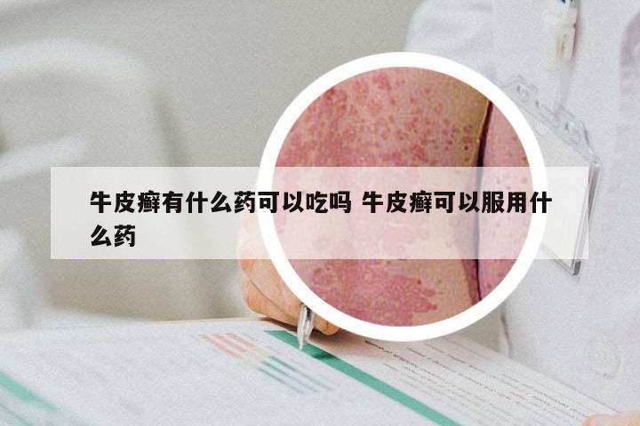 牛皮癣有什么药可以吃吗 牛皮癣可以服用什么药