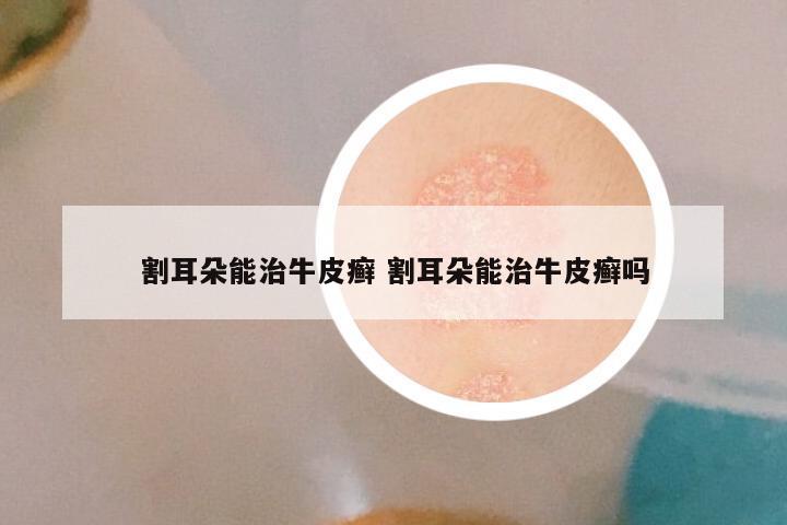 割耳朵能治牛皮癣 割耳朵能治牛皮癣吗