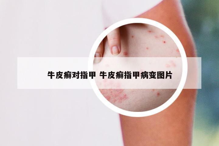 牛皮癣对指甲 牛皮癣指甲病变图片