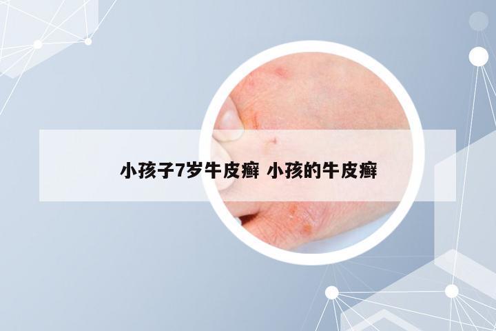 小孩子7岁牛皮癣 小孩的牛皮癣