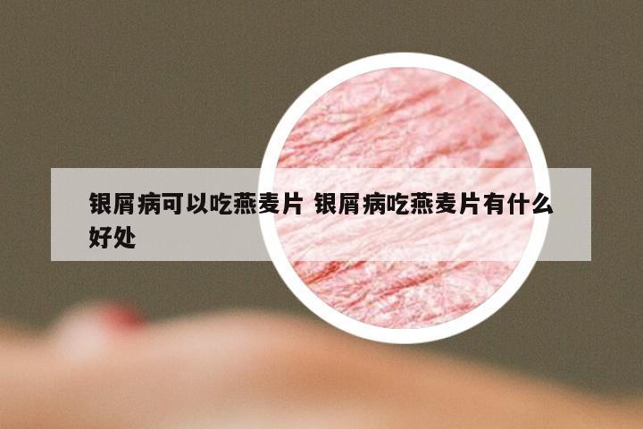 银屑病可以吃燕麦片 银屑病吃燕麦片有什么好处