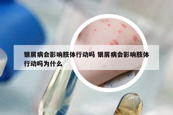 银屑病会影响肢体行动吗 银屑病会影响肢体行动吗为什么