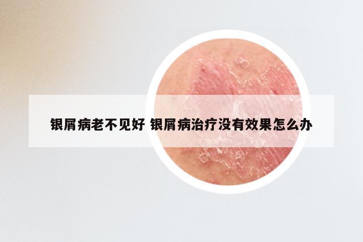 银屑病老不见好 银屑病治疗没有效果怎么办