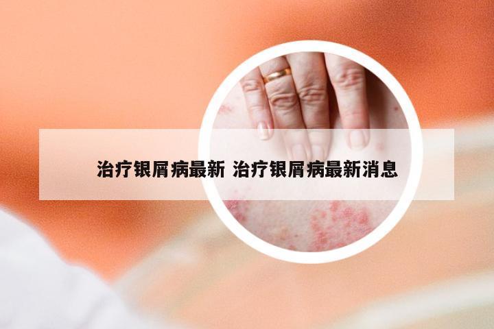 治疗银屑病最新 治疗银屑病最新消息