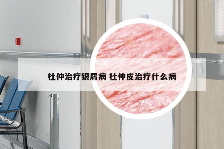 杜仲治疗银屑病 杜仲皮治疗什么病